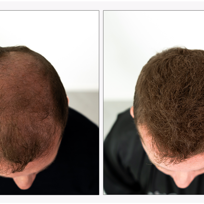 UVI Hair vlakna za kosu, DARK BROWN / Tamno smeđa (velika 27,5 g, do 50 nanosa)